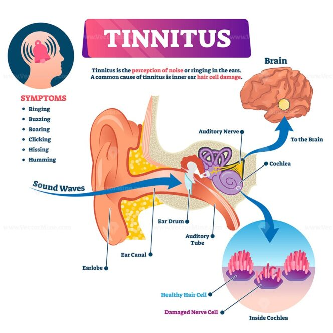 Tinnitus of the Ear