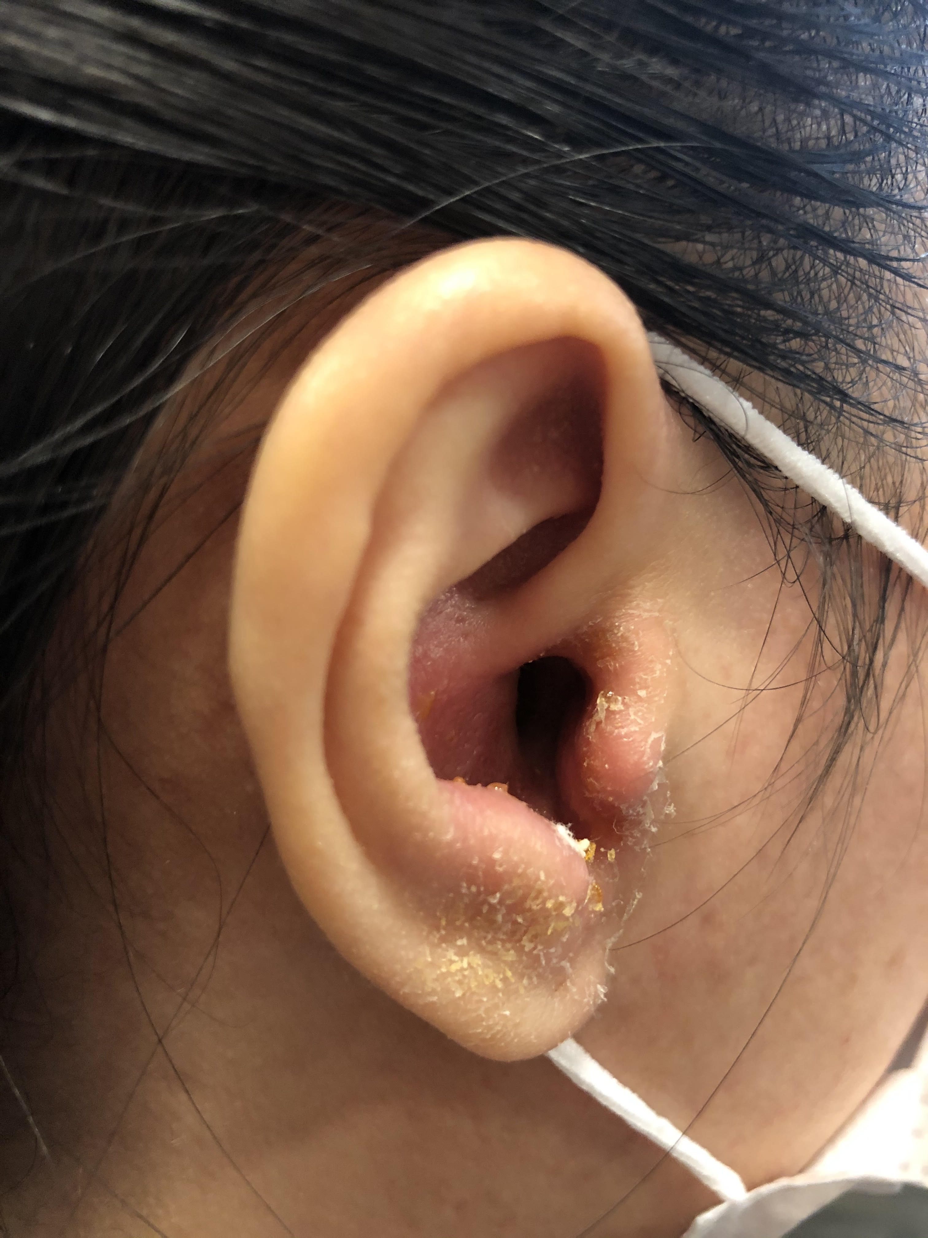ENT infections in Covid 19 times ENT Specialist Singapore
