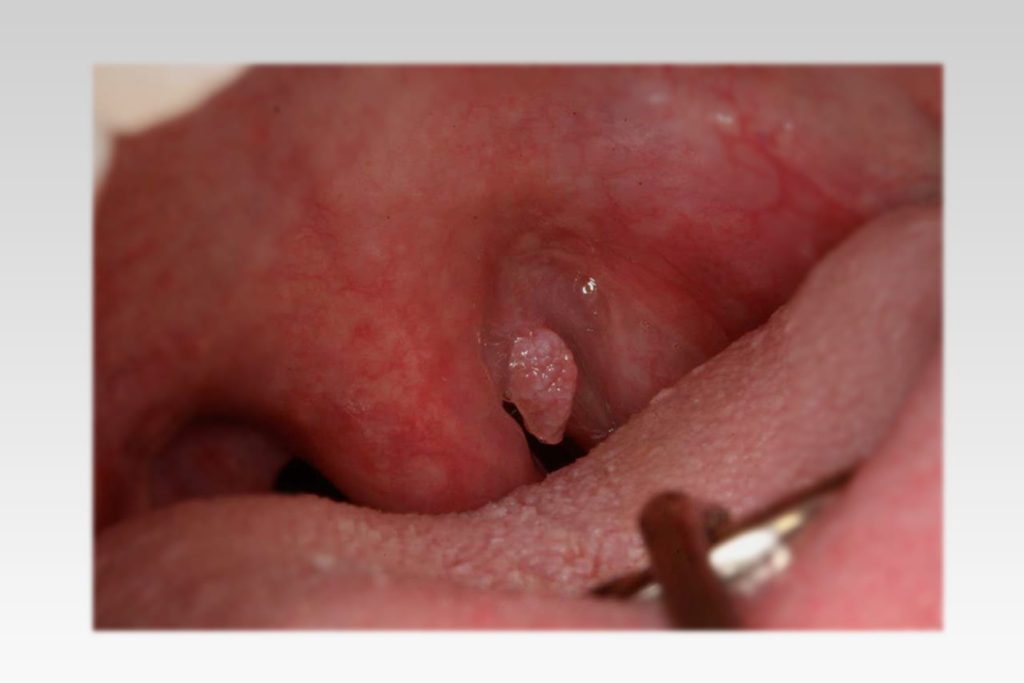 papilloma on the uvula)