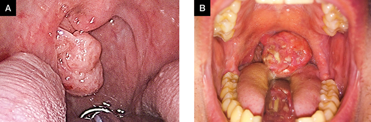 Amanda recommends best of Adult throat infection throat infection Adult