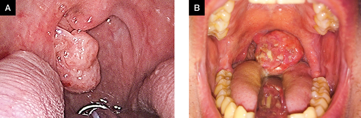 hpv lesion throat