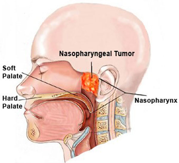 nasopharyngeal carcinoma symptoms