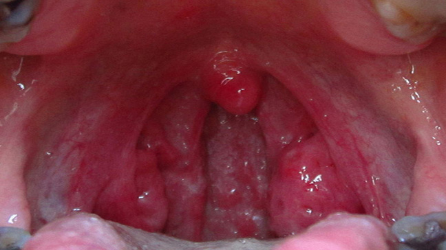 Throat Pics