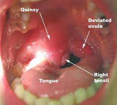 clinical junior.com - quinsy peritonsillitis management treatment incision  drainage