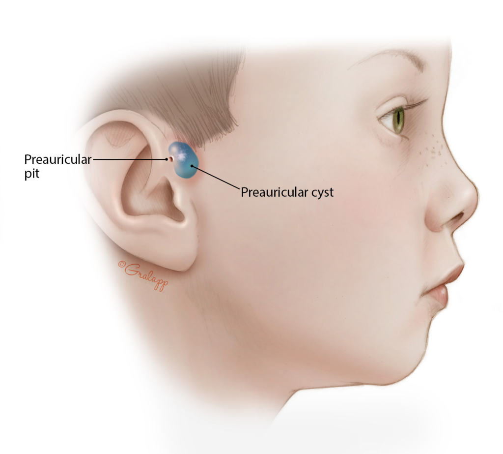 Preauricular Sinus Ear 