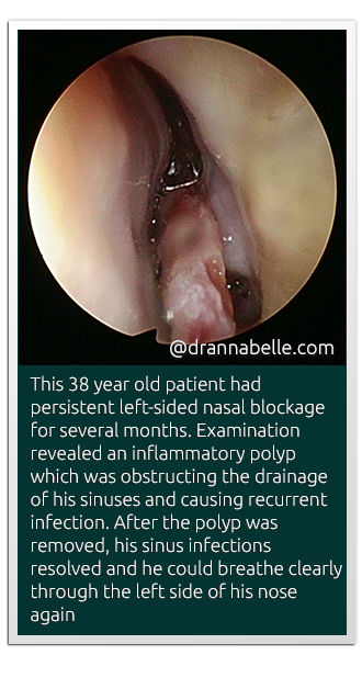 Nose And Sinus Problems Mount Elizabeth Novena