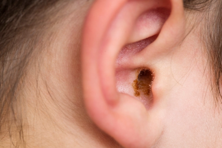 Ear Discharge: How to Get Better