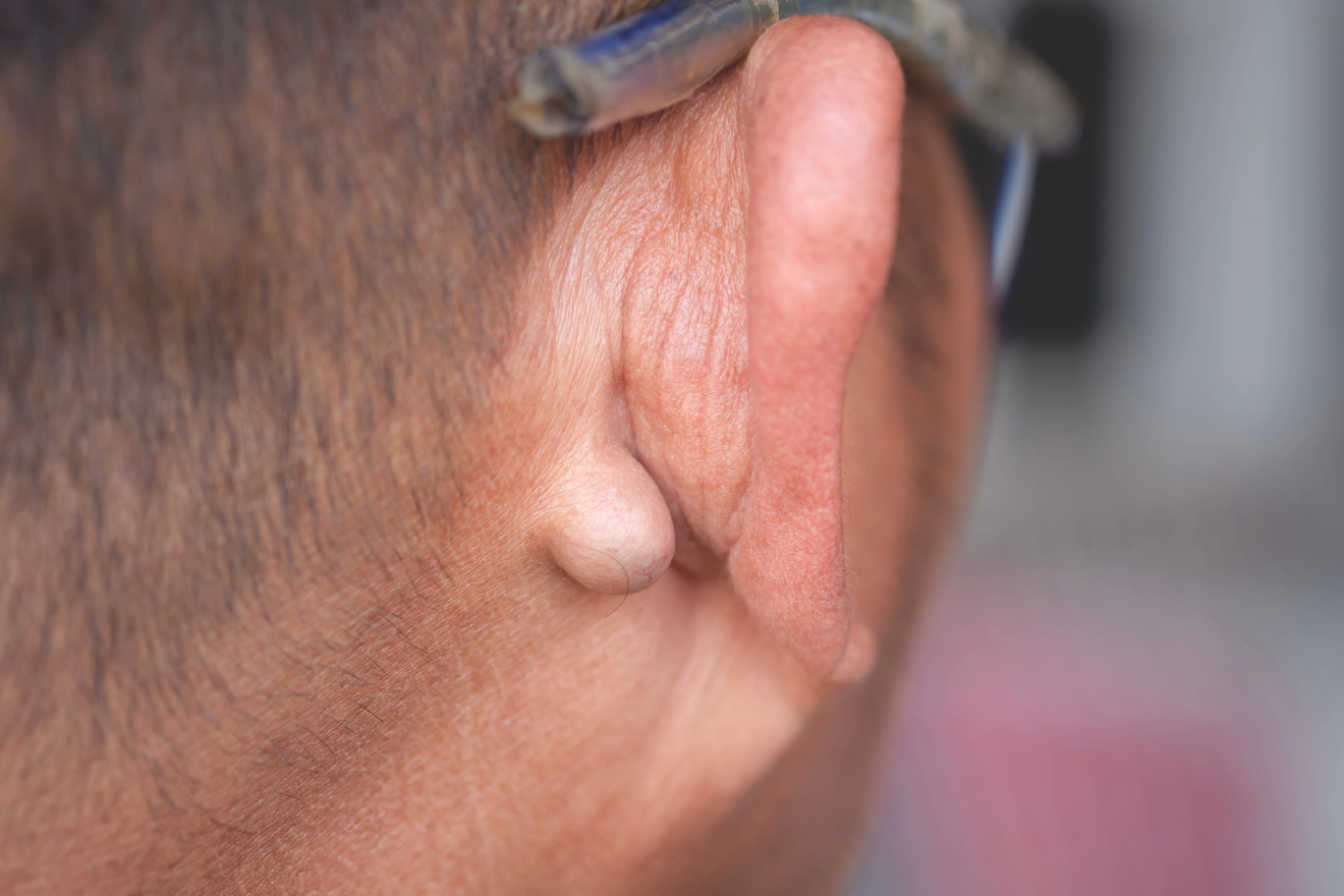 Ear Lump and Ear Cyst: How to Get Better