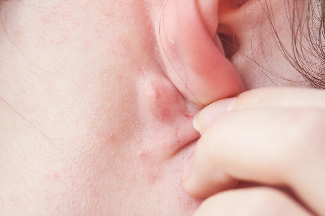 Lump on Ear: How to Get Better