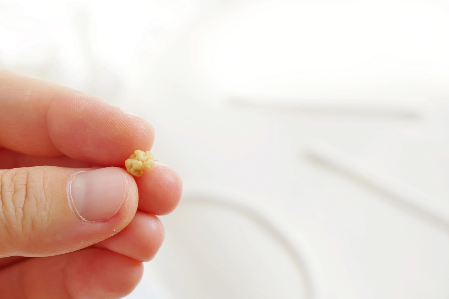 Tonsil Stones: How to Get Rid of Them