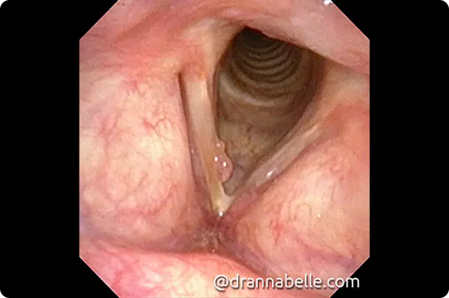 Larynx view after treatment