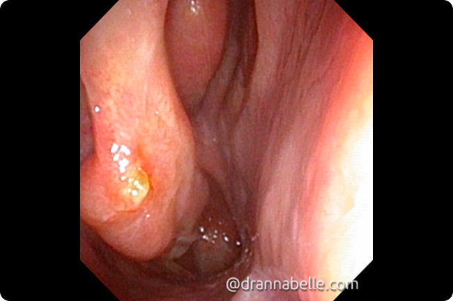 Two months after turbinate reduction procedure