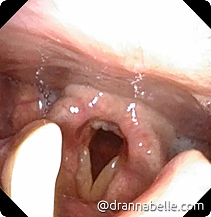 Acid reflux causing chronic inflammation of the voice box