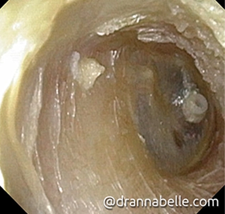 Ventilation tube inserted for persistent glue ear