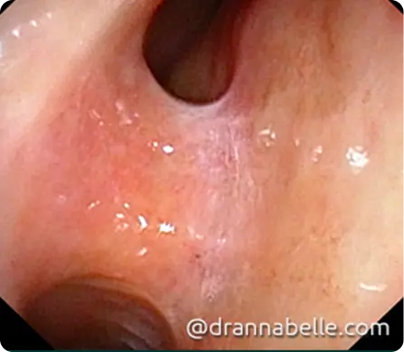 A band of scar tissue between the turbinate and the nasal septum