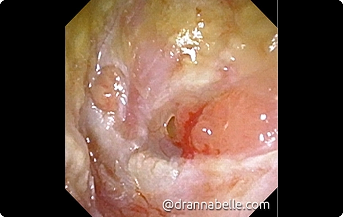 Active left eardrum infection with perforation
