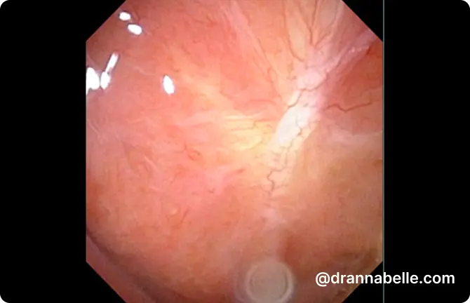 Postnasal space after adenoidectomy