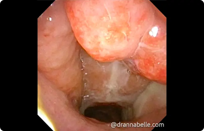 Enlarged and inflamed adenoid tissue covered in thick yellow mucus