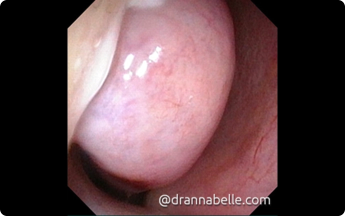 Enlarged turbinate tissue inside the nose may sometimes be mistaken for a nasal polyp.