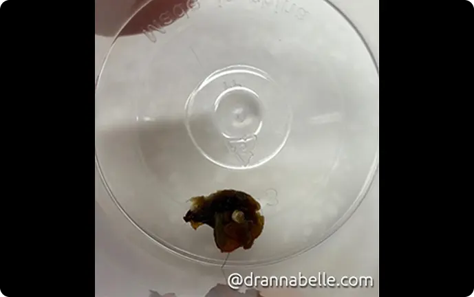 Hearing aid component embedded in earwax