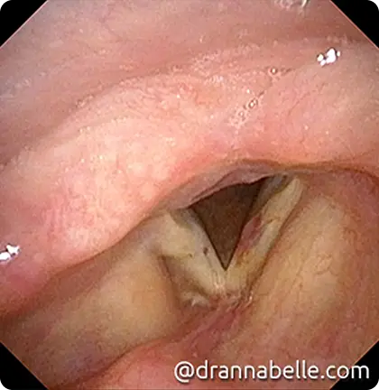 Haematoma on the left vocal cord from excessive coughing