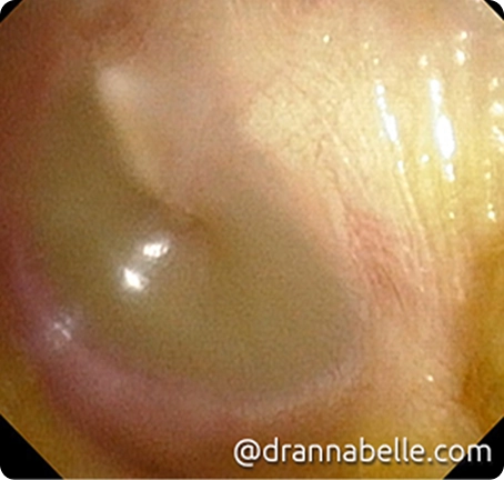 Frank yellow pus behind a bulging left eardrum