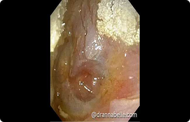 Fungal spores seen inside the left ear