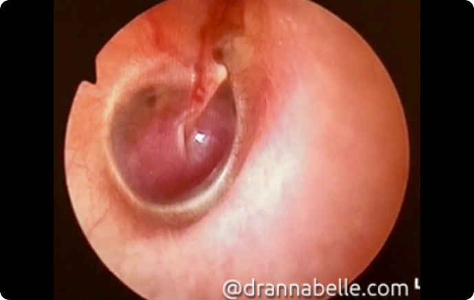 Glomus tumour appearing as a pulsating reddish mass