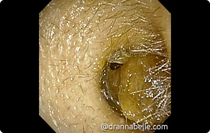 Huge impacted wax plug blocking the ear canal