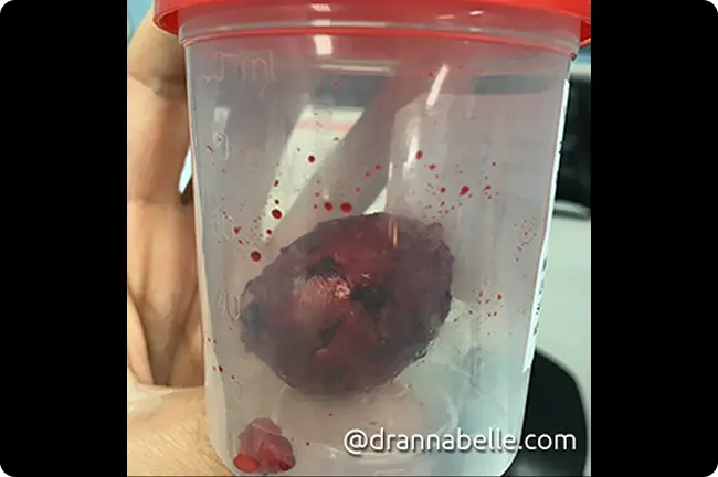 A large thyroid nodule removed during hemithyroidectomy