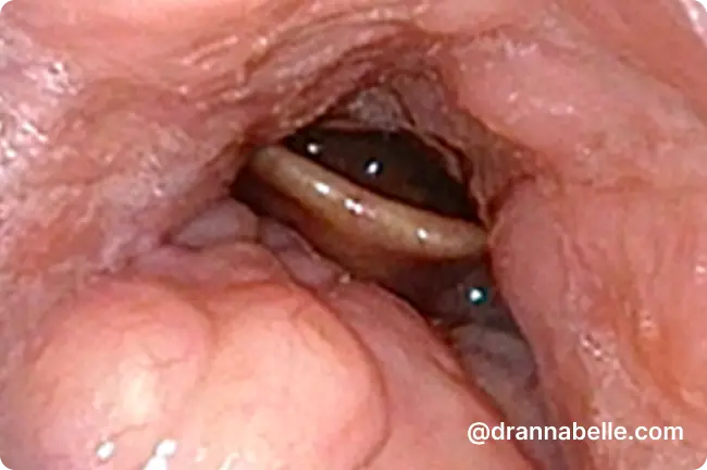 Mandivular advancement device used to treat obstructive sleep apnoea