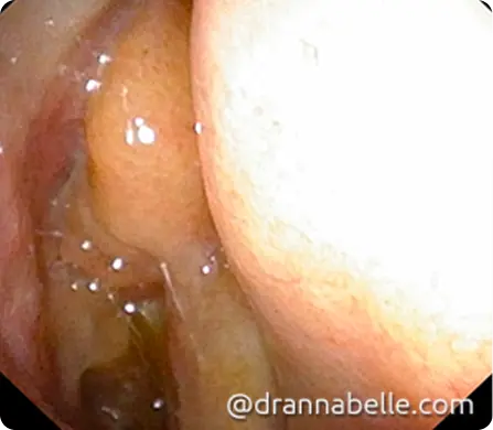 Nasal polyps originating from a thickened lining of the nose