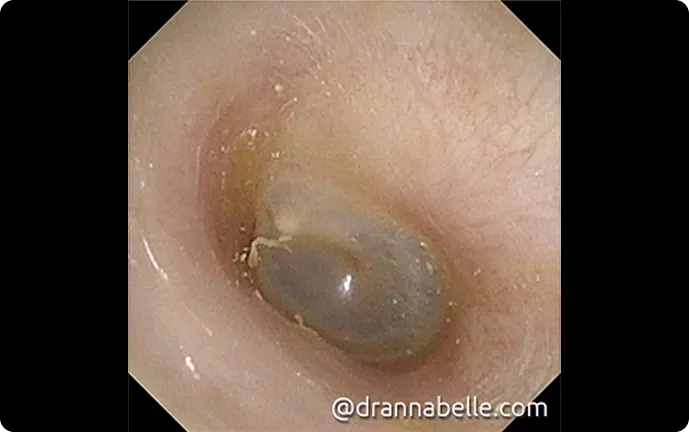 Normal left eardrum and ear canal