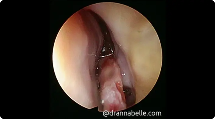 Inflammatory polyp causing left-sided nasal blockage