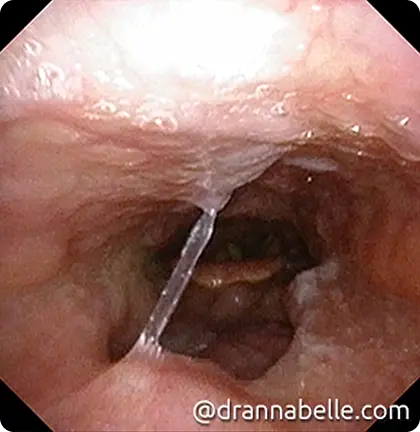 Postnasal drip causing a persistent cough
