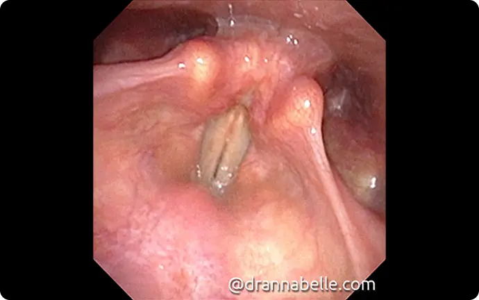 Cyst growing next to the epiglottis