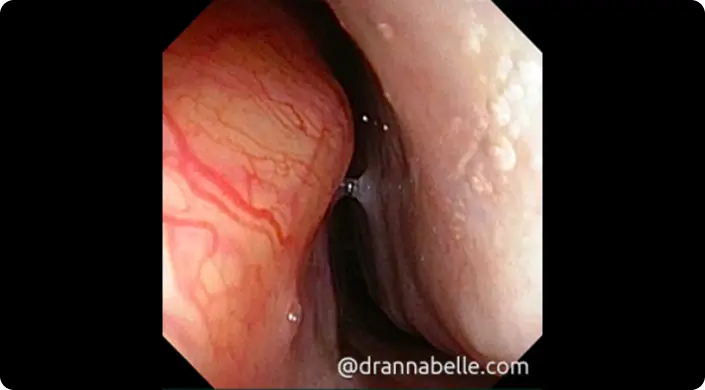 Prominent blood vessels close to the surface of the nasal lining