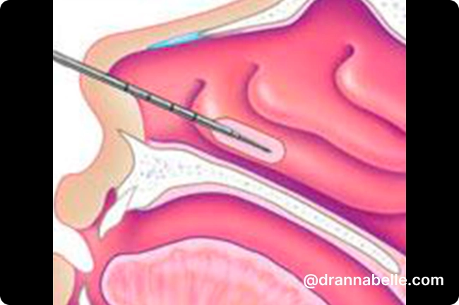 Radiofrequency Ablation of Inferior Turbinates (RFIT)