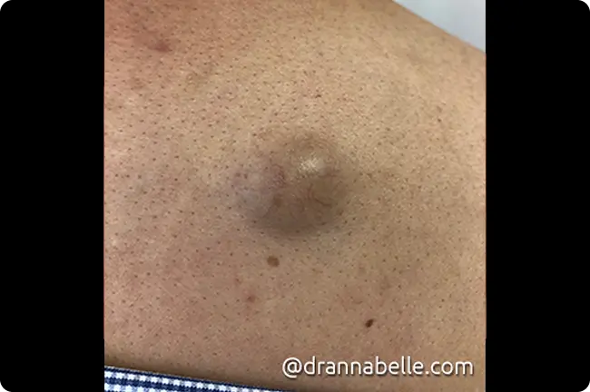 Enlarging painful skin cyst on the back of the neck