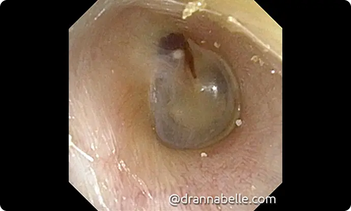 Small blood clot on the right eardrum after a toy car wheel was inserted