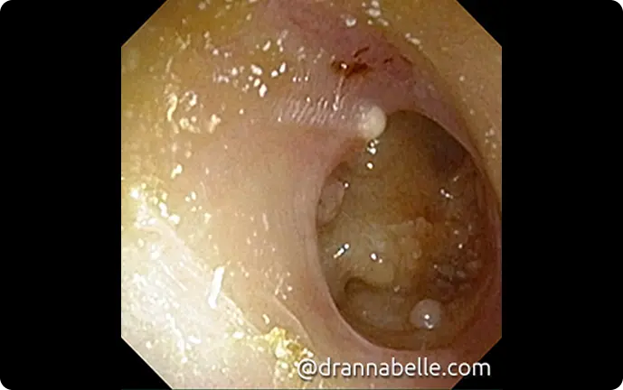 Large perforation of the right eardrum