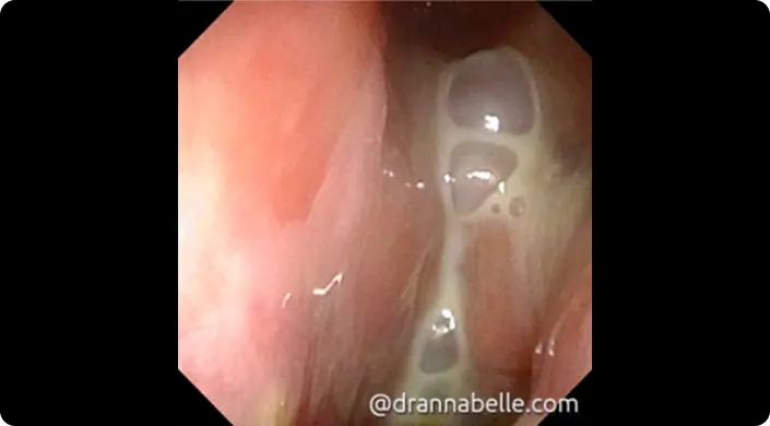 Recurrent sinus infections with thick pus in the nose and sinuses