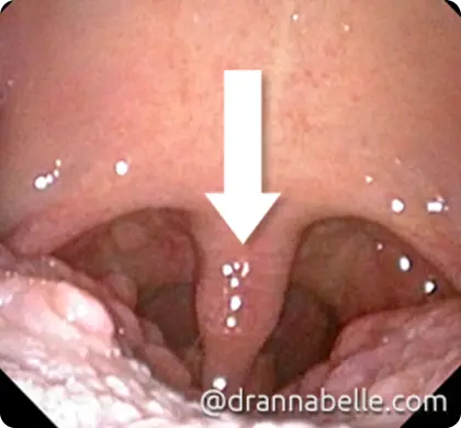 Surgery for OSA