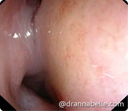Swollen turbinate soft tissue inside the nose blocking off the nasal passage