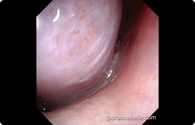 Enlarged pale turbinate tissue blocking the nasal airway