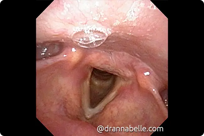 Vocal cords coming together when speaking