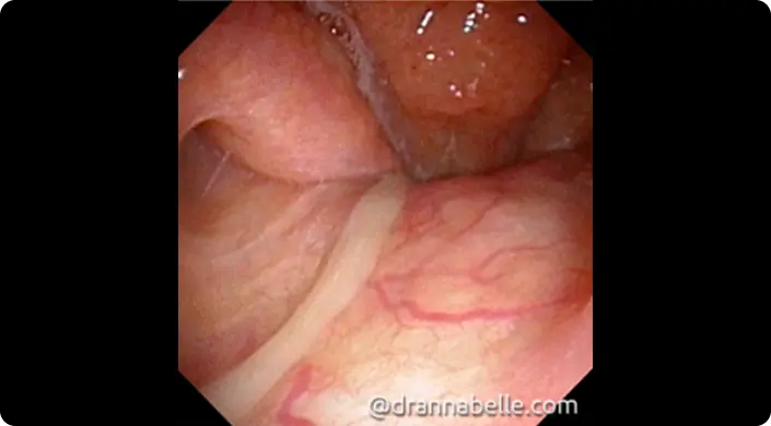 Thick trail of yellow pus coming from the sinuses