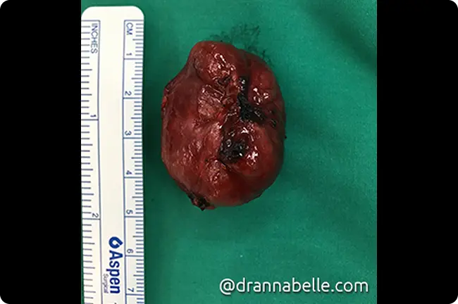 A large thyroglossal cyst after surgical removal