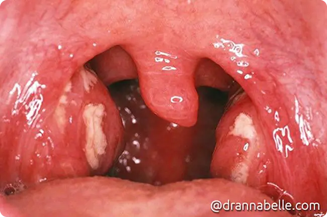 Severe tonsil infections with pus around the tonsils