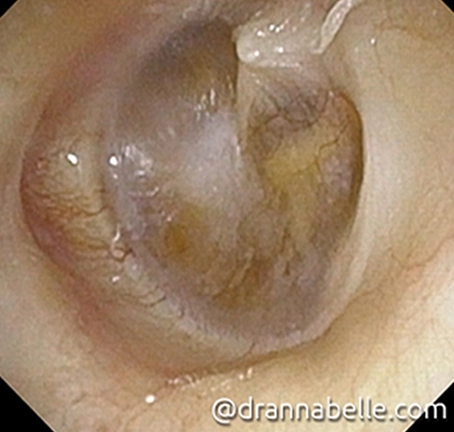 Turbid yellowish fluid behind the left eardrum